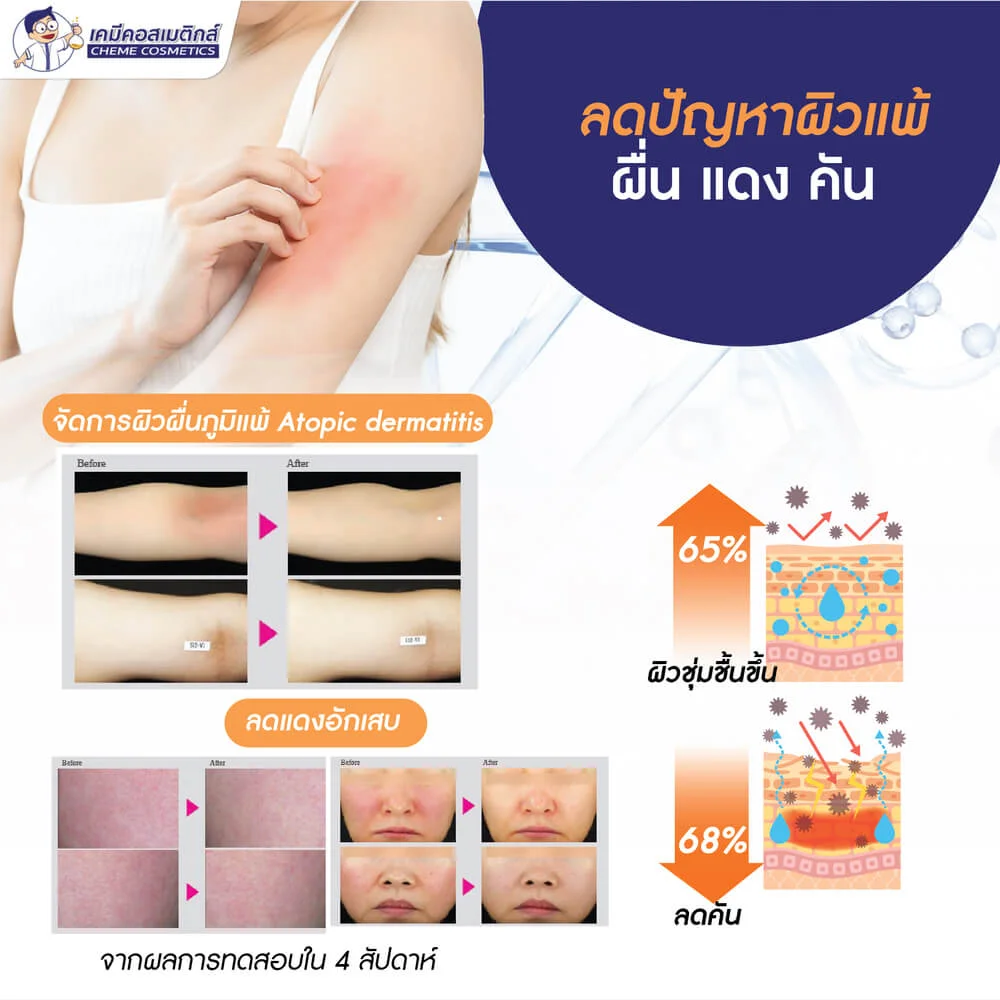 CG-PTX (Botulinum Toxin type C) โบทูลินั่มท็อกซินเปปไทด์ชนิดซี ตัวแรกของโลก นวัตกรรมลดเลือนริ้วรอย สิว ผิวอักเสบ และบรรเทาปวด แบบไร้เข็ม (Needle Free) - Image 4