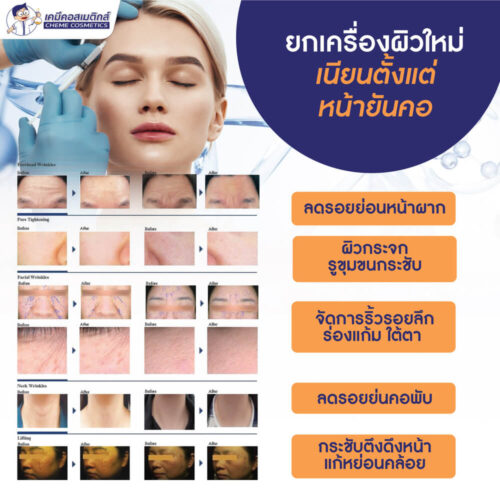 CG-PTX (Botulinum Toxin type C) โบทูลินั่มท็อกซินเปปไทด์ชนิดซี ตัวแรกของโลก นวัตกรรมลดเลือนริ้วรอย สิว ผิวอักเสบ และบรรเทาปวด แบบไร้เข็ม (Needle Free) - Image 5