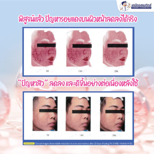 SHINE+ Hwhite M-BS นวัตกรรมซุปราโมเลกุลาร์ที่รวมซาลิไซลิกแอซิด (ช่วยผลัดเซลล์ผิว ลดสิว) และบีเทน (เพิ่มความชุ่มชื้น ลดการระคายเคือง) เข้าด้วยกัน ทำให้ได้สารที่มีประสิทธิภาพดีกว่า ระคายเคืองน้อยกว่า และเสถียรกว่าซาลิไซลิกแอซิดทั่วไปถึง 30 เท่า - Image 5